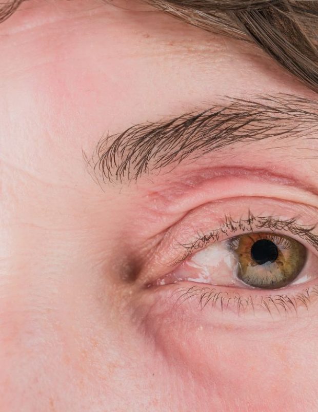 Ophtaliberte -oeil-rouge